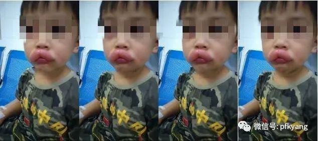 男孩吃葡萄過敏腫成嘟嘟嘴怎么回事？畫面詳情曝光網(wǎng)友忍不住笑了(圖2)