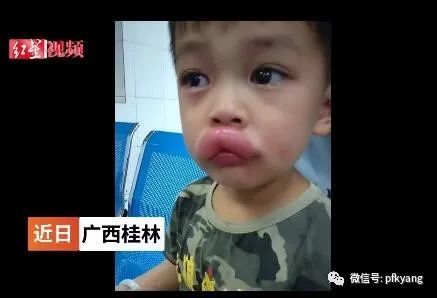男孩吃葡萄過敏腫成嘟嘟嘴怎么回事？畫面詳情曝光網(wǎng)友忍不住笑了(圖5)